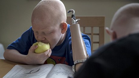 Video, Fotos: Las escalofriantes historias de los albinos en Tanzania