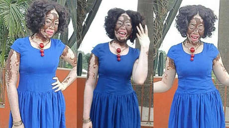 Cómo esta enfermera con vitíligo superó el 'bullying' y se convirtió en modelo
