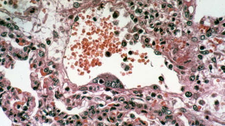Rebrota un virus mortal que no tiene cura y deja sus primeras víctimas 