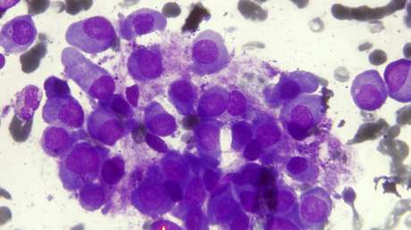 Hallan el "talón de Aquiles" del cáncer: ciertos tumores se autodestruyen por efecto de fármacos ya existentes