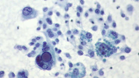 Pierde gran parte del cuello por culpa de un lunar y ahora conciencia al mundo sobre el riesgo del melanoma