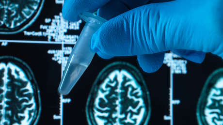 Dos farmacéuticas aseguran que su medicamento frena la evolución del alzhéimer, ¿por qué puede ser revolucionario?