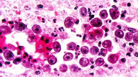 Muere en EE.UU. un hombre por una ameba en el agua del grifo que devoró su cerebro