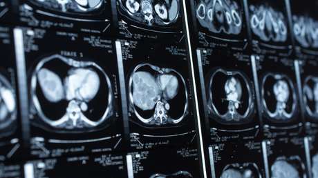 Crean en Irán una prueba para detectar infartos con solo una gota de sangre del dedo