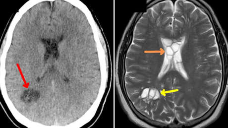 Come tocino poco cocido y se le mete una tenia en el cerebro