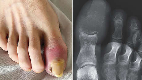 Descubre una extraña hinchazón en los dedos y resulta ser un signo poco común de cáncer
