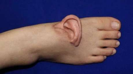 Milagro médico: mujer china llevó su oreja en el pie por 5 meses antes de ser reimplantada