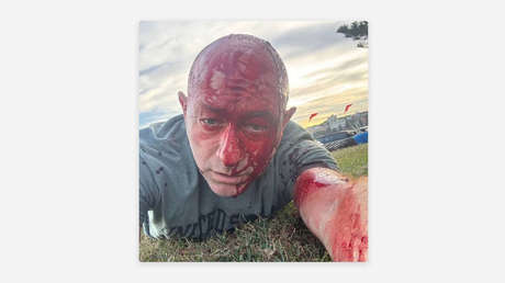 Escalofriante imagen del líder de la comunidad judía tras resultar herido en el tiroteo masivo de Australia