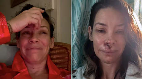 Una actriz de 'El hobbit' y Marvel sufre daño cerebral tras grave caída