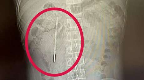 Acude al hospital por un dolor abdominal y le descubren un insólito objeto en su interior