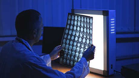 Médicos rusos realizan operación pionera de aneurisma cerebral
