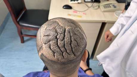 Hombre vivió años con una rara afección que 'convirtió' su cabeza en un cerebro